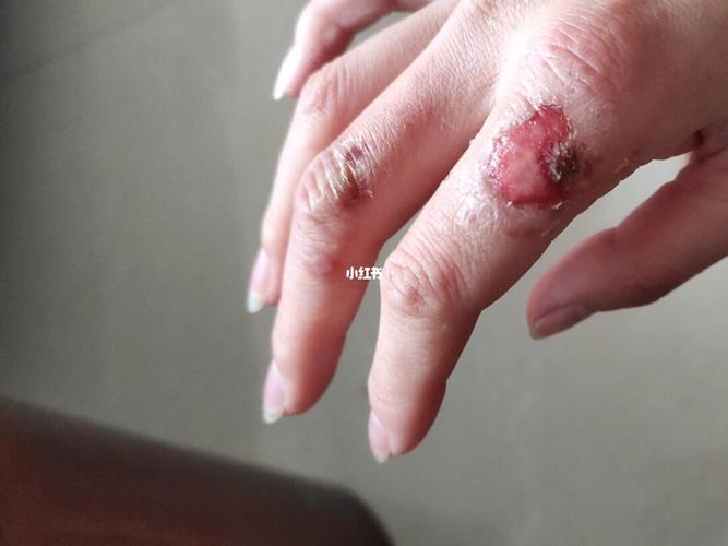 不忍直视的冻疮.有像我这样长冻疮,痒到抓破皮,烂成这样的吗?