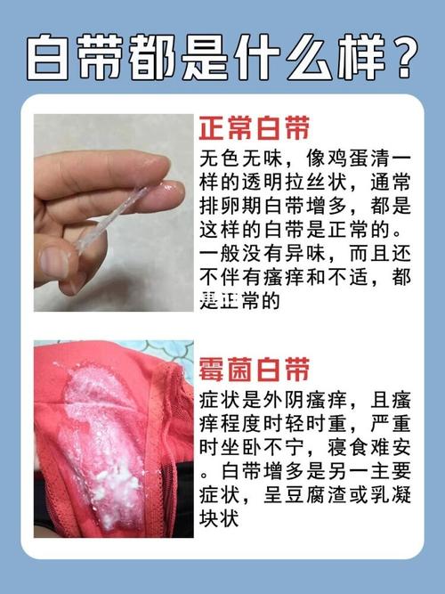 没想到滴虫就这么好了 被异常的白带困扰挺久的了,没男友之前一直都是