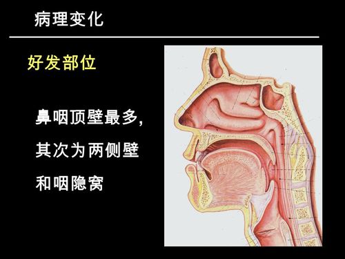 鼻咽腔鼻咽肿瘤咽隐窝在什么位置鼻咽部位图片鼻咽腔位置图鼻咽癌位置