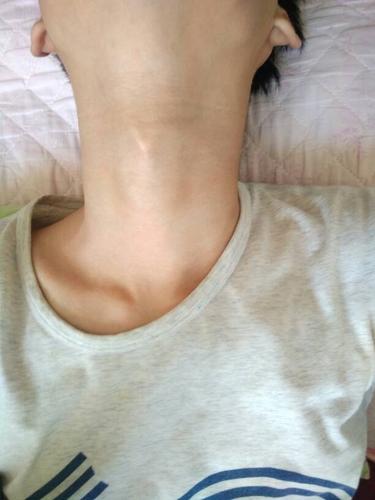 喉结上面长了个半圆小硬块皮肤里面怎么回事啊