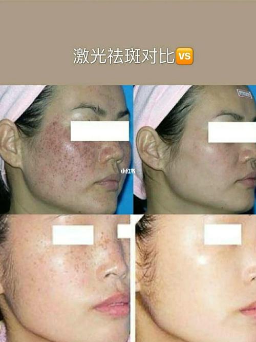 皮秒祛斑,做完皮肤会变薄吗?