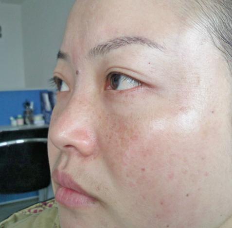 为什么脸上有蝴蝶斑 这5大元凶你了解几个?