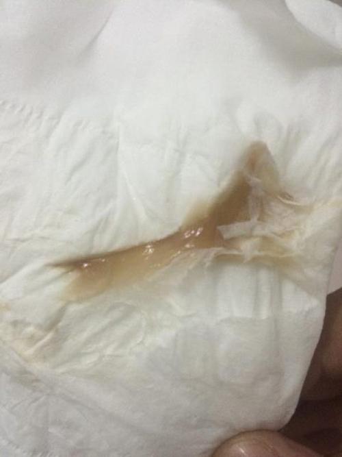每次排卵期的时候都会有像鼻涕一样的粘粘的褐色分泌物
