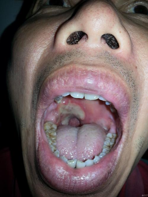 10余天前复出现右侧扁桃体窝处小指头大小溃疡,经反