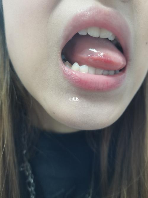 打舌钉的第三天!图片敲恶心 慎入嗷_拍照_冰激凌_发炎