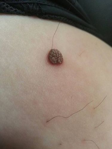 这种东西人人身上都有,出现这几种情况,可能是癌变信号!