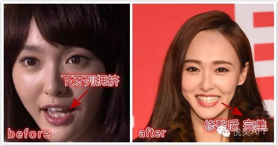 你是地包天?都以为明星好当,原来偷偷做了截骨术