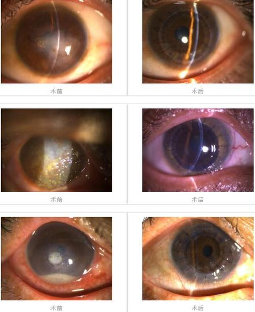 荆门爱尔眼科分享角膜炎治疗真实案例