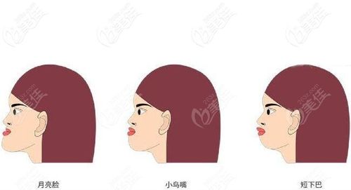 成都矫正地包天哪家医院好对比后发现几家矫正兜齿价格不贵的