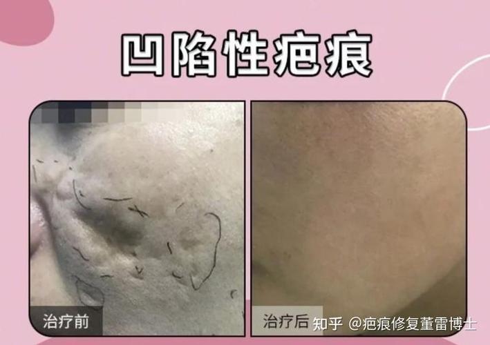 凹陷疤痕能去除吗?