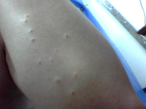 这属于艾滋病初期症状么?