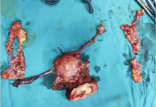 35岁女子患早期宫颈癌:诊断早 手术切除效果好