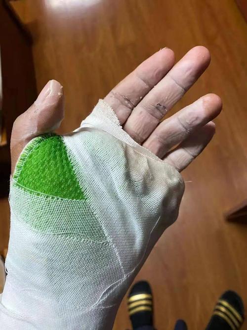 海天大道消防救援站消防员林利旭的手,在救援中受伤,绷带以外的部位