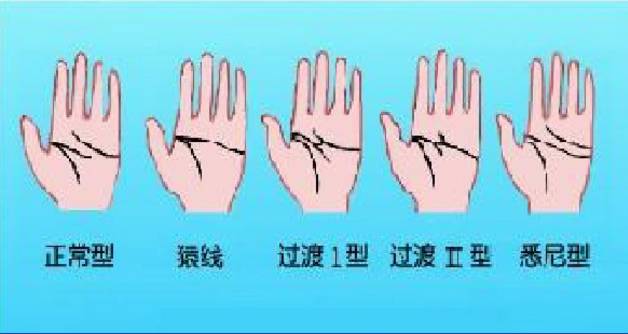 唐氏综合征有哪些特征?