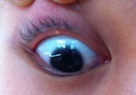 眼睑上面常见的白色小圆点到底是什么