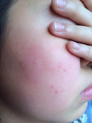 脸上长皮癣一周,不痒,偶尔刺痛感!