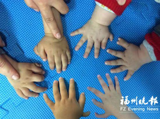 福州一医院一天收治6个"六指娃"手术宜早不宜迟