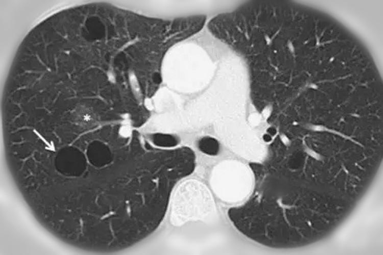 如何区分"肺大疱","肺气囊","肺囊肿"