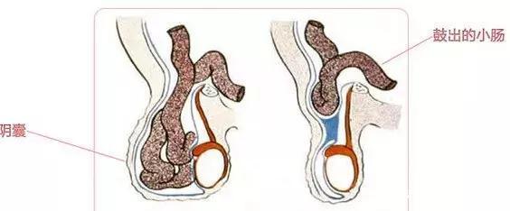 男孩蛋疼3天睾丸被切除!妈妈的一个疏忽毁了孩子的终身"性福"