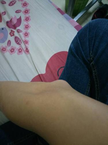 胳膊肘 肿个包很疼