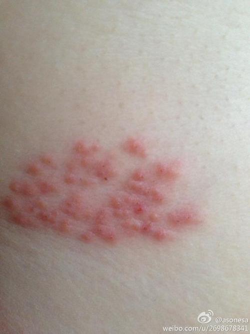 我母亲腰上不知什么原因起了一片小疹子?