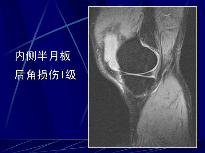 内侧半月板 后角损伤i级