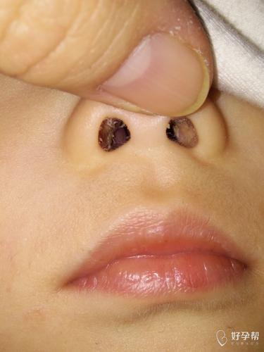宝宝鼻孔里有个小疙瘩