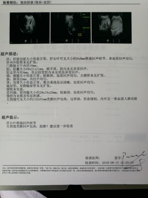 巨大副脾并脾蒂扭转,脾功能亢进一例