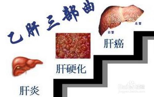 年后发现乙肝病情加重该做哪些检查呢