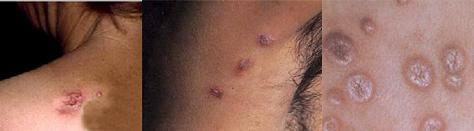 二期梅毒皮疹症状表现