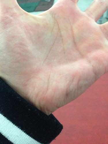 我的小鱼际是否萎缩?