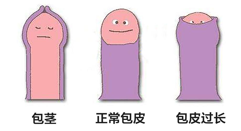 1,翻转包皮,平常只要注意时常翻转一下,并用清水清洗包皮冠状沟即可.