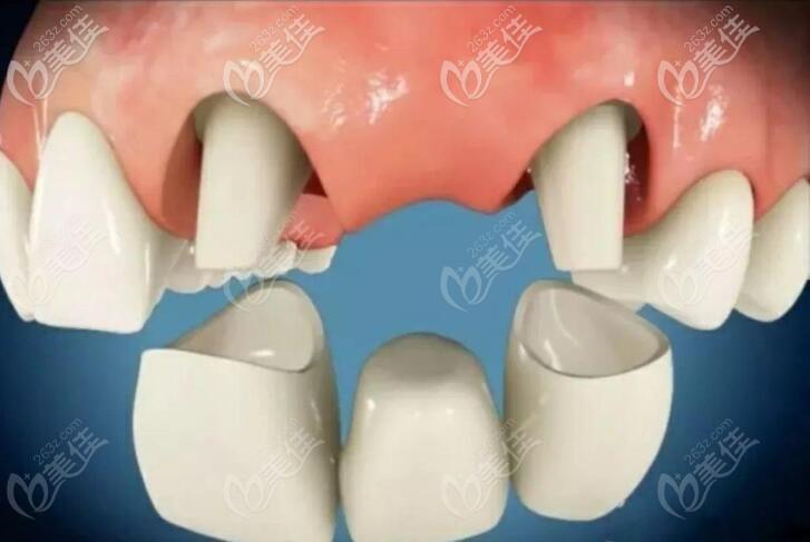 不要再傻傻问种植牙和搭桥牙哪个好了内行人都知道固定烤瓷桥不便宜还