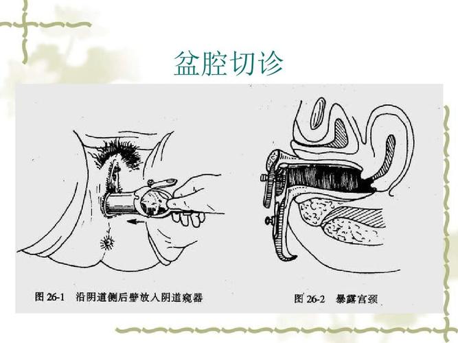 盆腔切诊