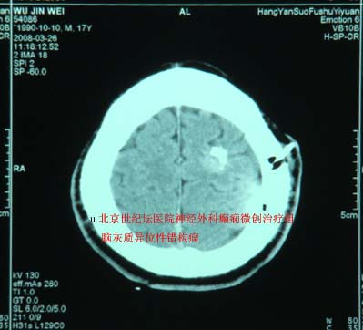 脑灰质异位症1例