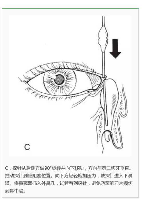 眼病百科 泪道 > 【眼科读书时间】鼻泪 【眼科读书时间】鼻泪管探通