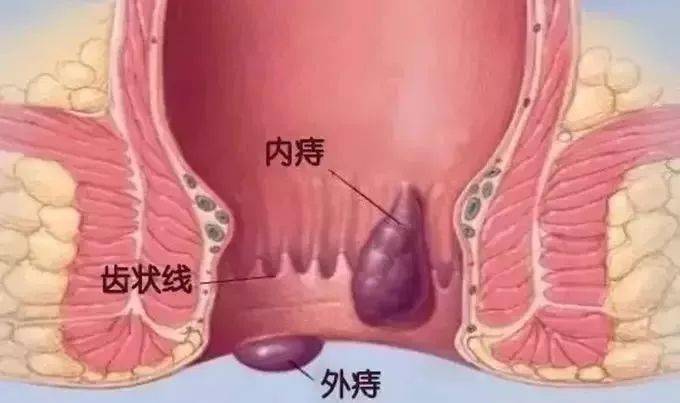 痔疮,长在肛门内外肛管直肠处大概2~4厘米左右的范围里,  内痔,外痔