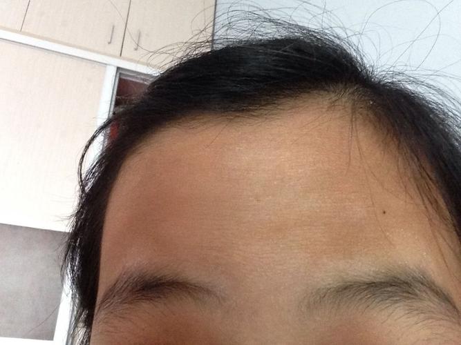 满意回答 一般来讲突出皮肤表面的是脂肪粒,随着新生儿蜕皮会自行