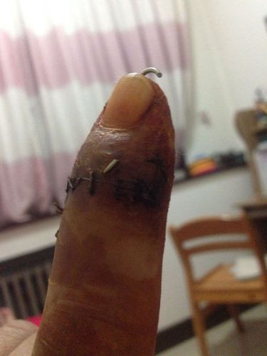 前段时间指头受伤,钉了两根钢针,一根2300,什么材质这么贵?