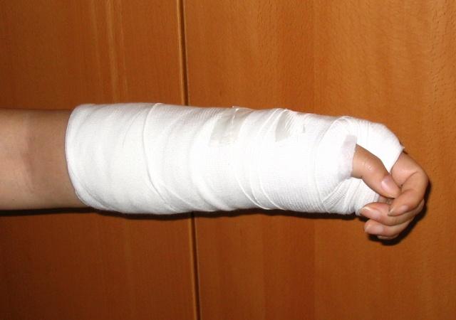 胫骨平台骨折合并后叉止点骨折采用新技术治疗的效果观察论文