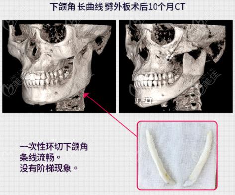 韩国女神整形做下颌角手术也好哦,没二次角效果图棒棒