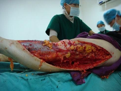 医院外科手术台上的第一手震惊图片