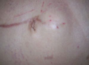 腹部包块的诊断