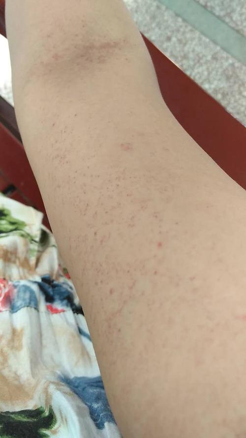 孕17周长了右手手臂出现紫癜,血小板值正常,医生说可以适量吃维c,该