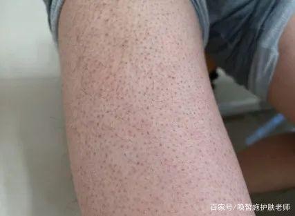 鸡皮肤是什么样的 这里有鸡皮肤各种症状图片