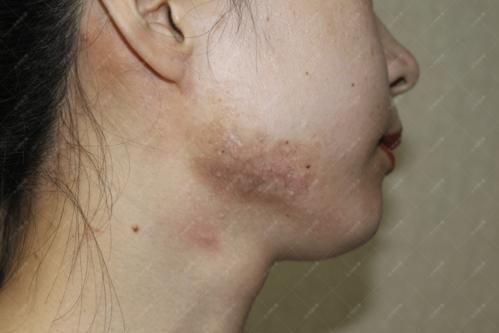 (疤康)这种不是痘痘,是疤痕疙瘩!