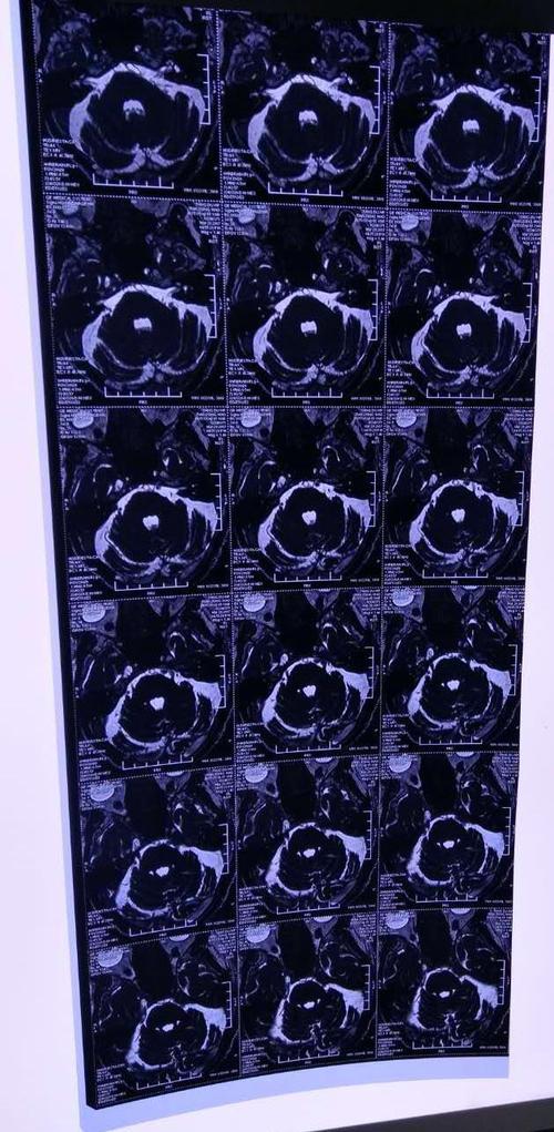 患者病情,病史,体征,影像学检查等确诊为颅内肿瘤导致的三叉神经痛