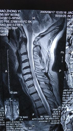 2005年所拍颈椎核磁共振照片.