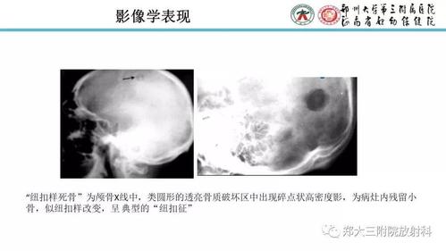 颅骨嗜酸性肉芽肿的病例分析