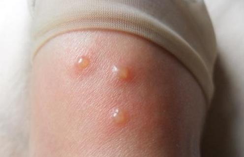 去除湿疹好方法